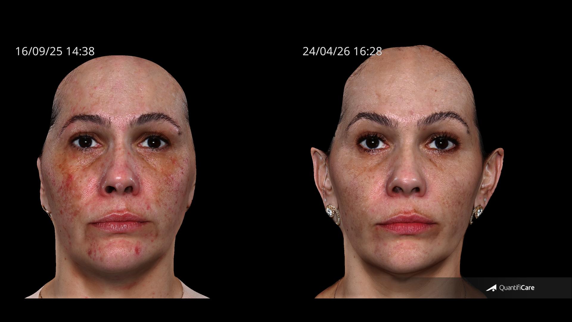 Antes e depois — Melasma & textura — depois