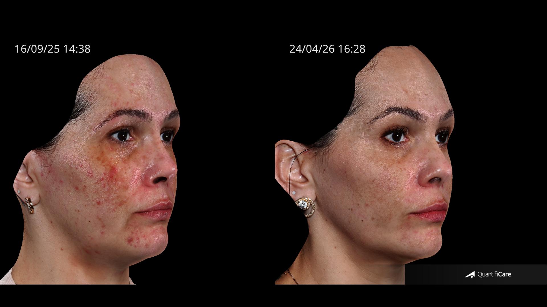 Antes e depois — Cicatrizes de acne — depois