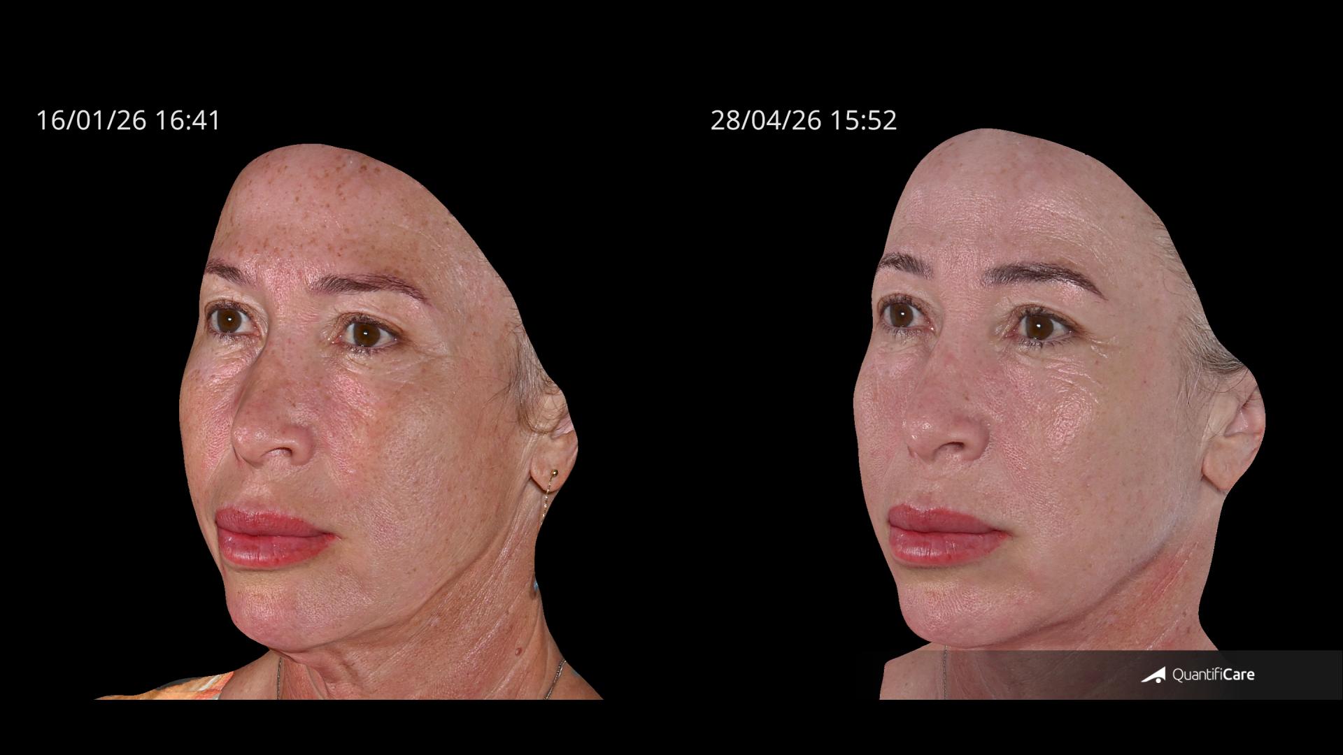 Antes e depois — Manchas & firmeza — depois