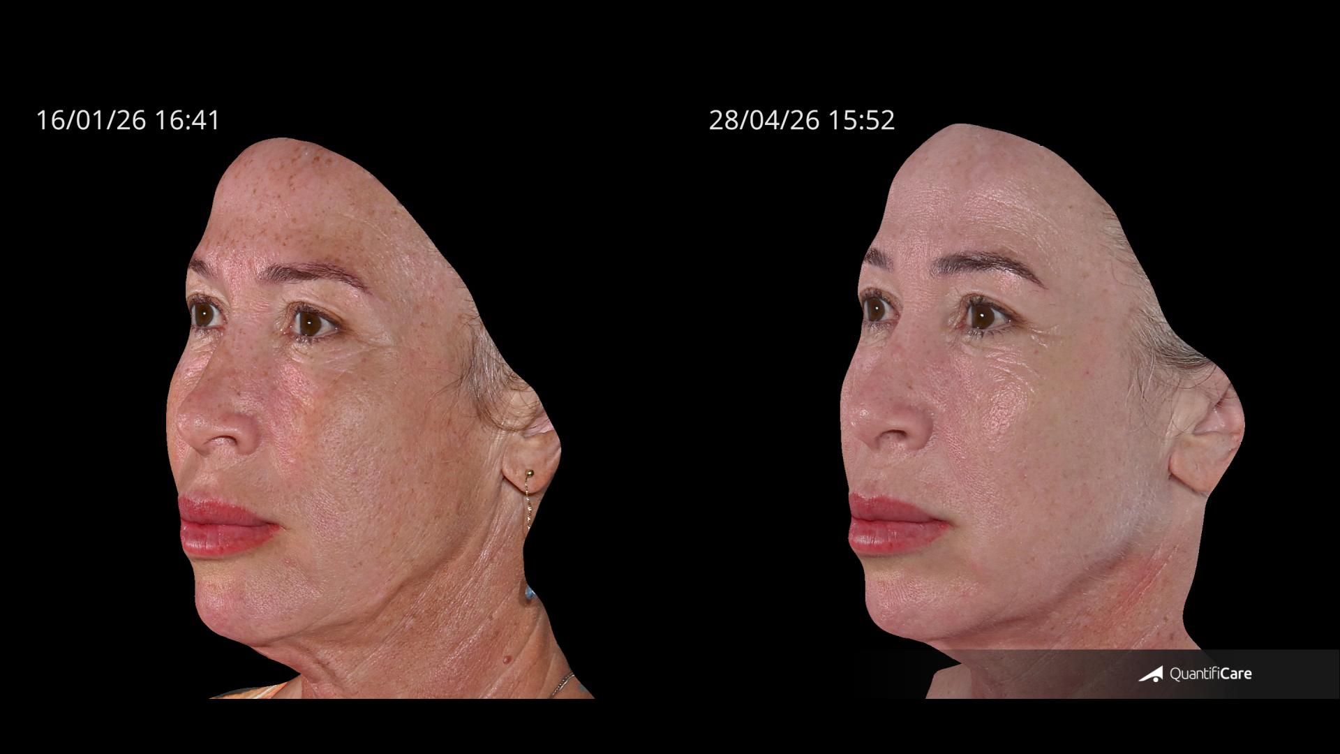 Antes e depois — Rejuvenescimento — depois